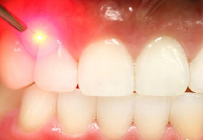 Киста зуба - причины и лечение